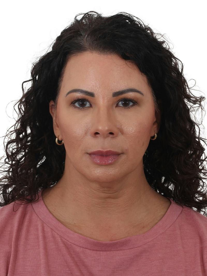 Blepharoplasty Before & After Gallery - Patient 392015 - Image 1