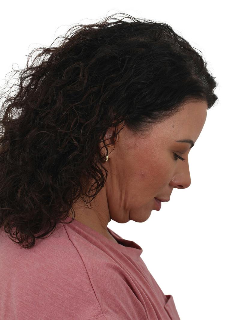 Blepharoplasty Before & After Gallery - Patient 392015 - Image 7