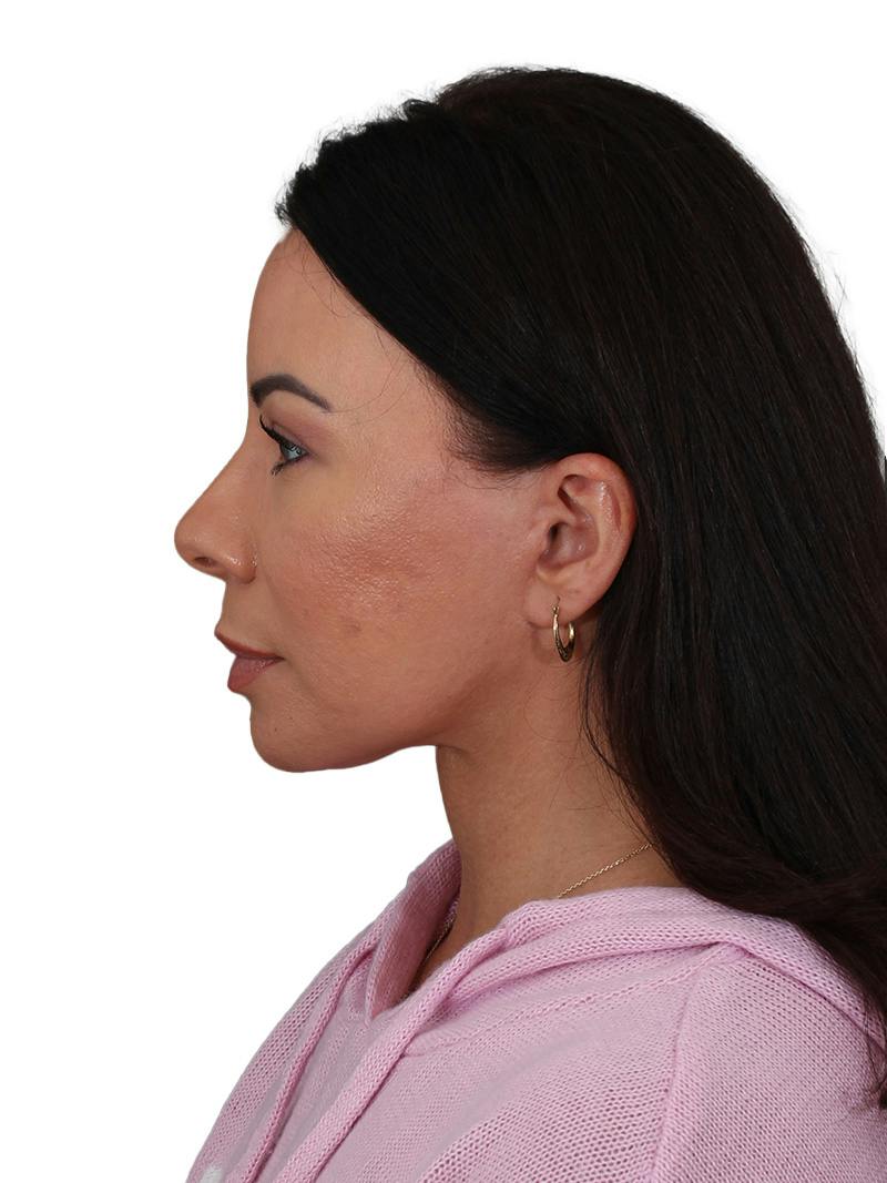 Blepharoplasty Before & After Gallery - Patient 392015 - Image 12