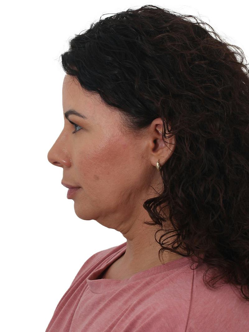 Blepharoplasty Before & After Gallery - Patient 392015 - Image 11