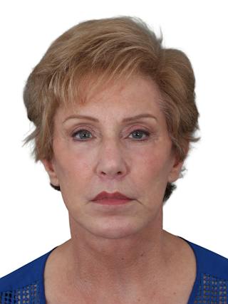 Blepharoplasty Before & After Gallery - Patient 189456 - Image 2