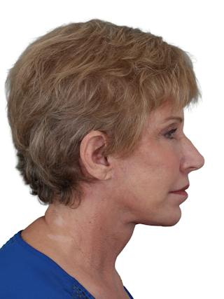 Blepharoplasty Before & After Gallery - Patient 189456 - Image 6