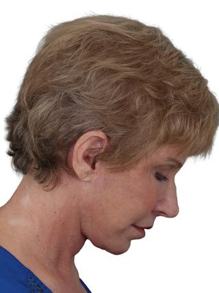 Blepharoplasty Before & After Gallery - Patient 189456 - Image 8