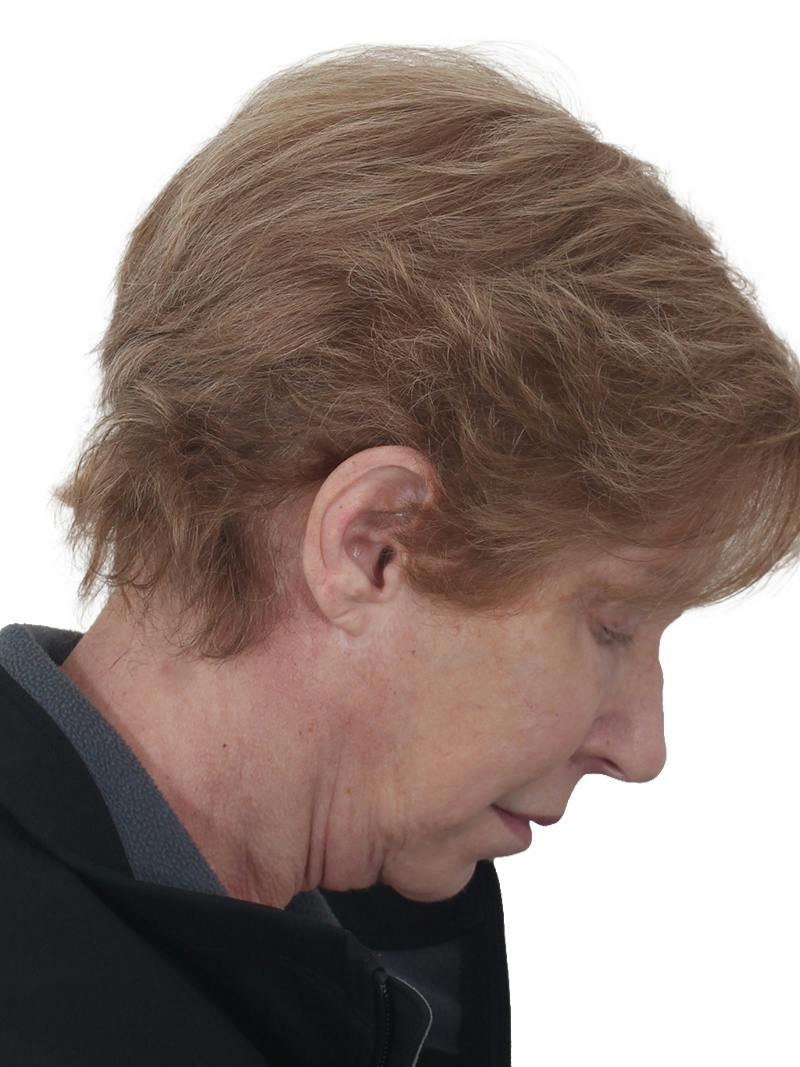 Blepharoplasty Before & After Gallery - Patient 189456 - Image 7