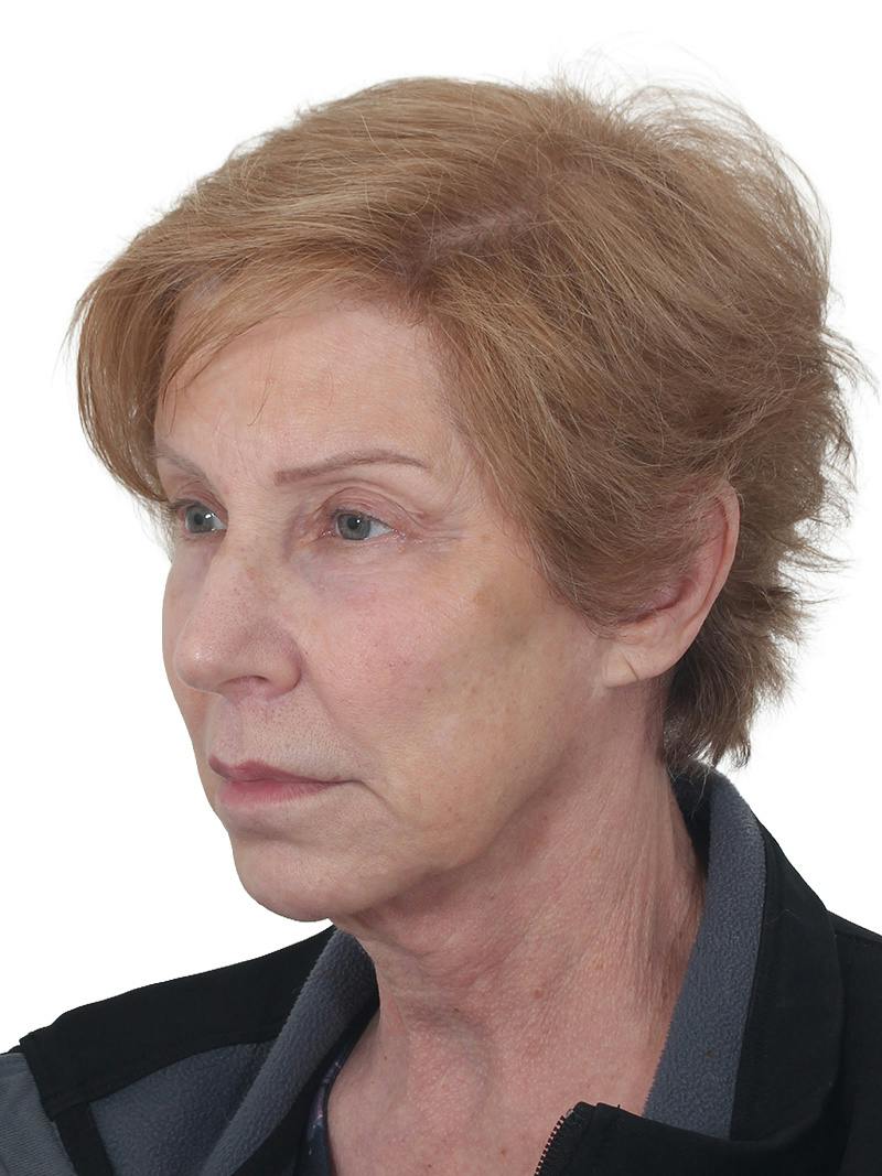 Blepharoplasty Before & After Gallery - Patient 189456 - Image 9