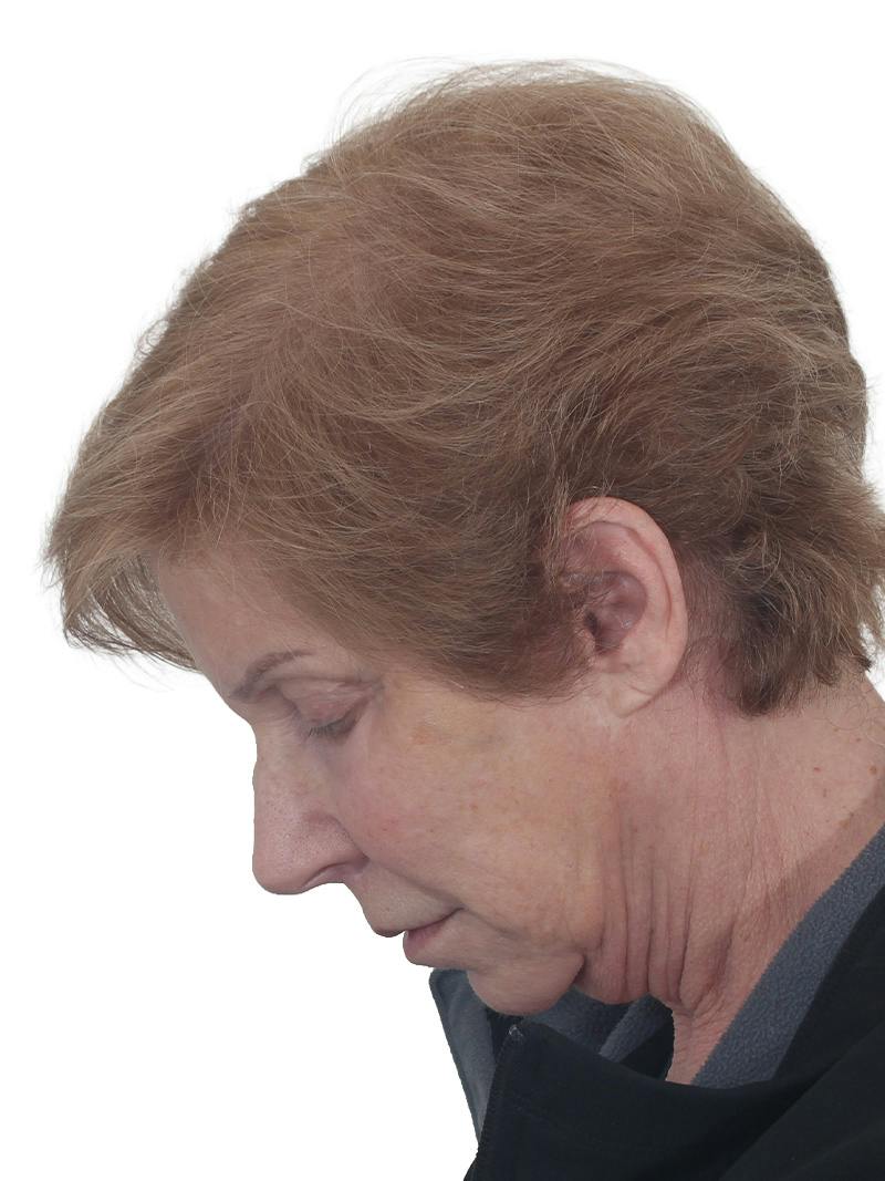 Blepharoplasty Before & After Gallery - Patient 189456 - Image 13