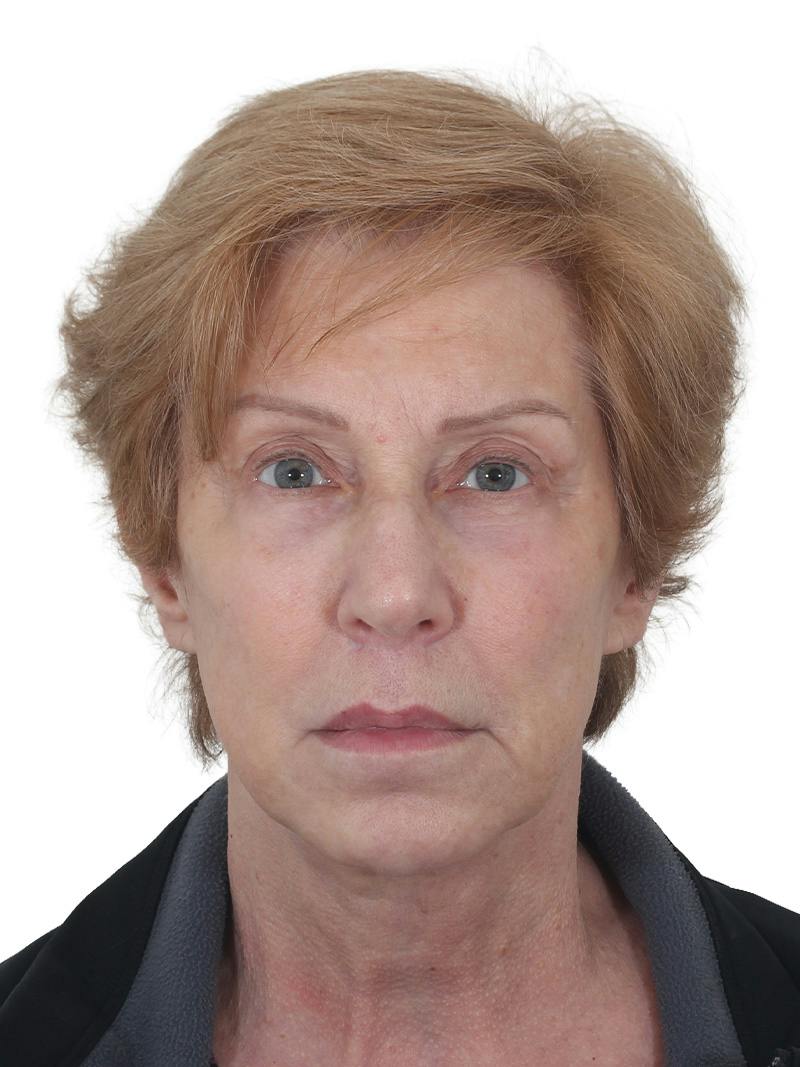Blepharoplasty Before & After Gallery - Patient 189456 - Image 1