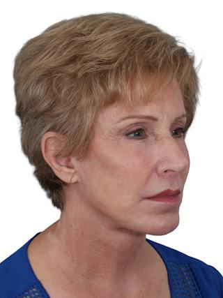 Blepharoplasty Before & After Gallery - Patient 189456 - Image 4