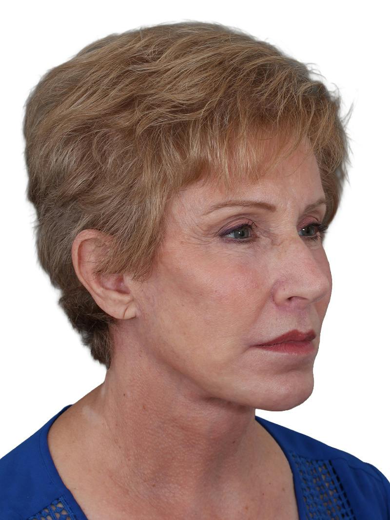 Blepharoplasty Before & After Gallery - Patient 189456 - Image 4