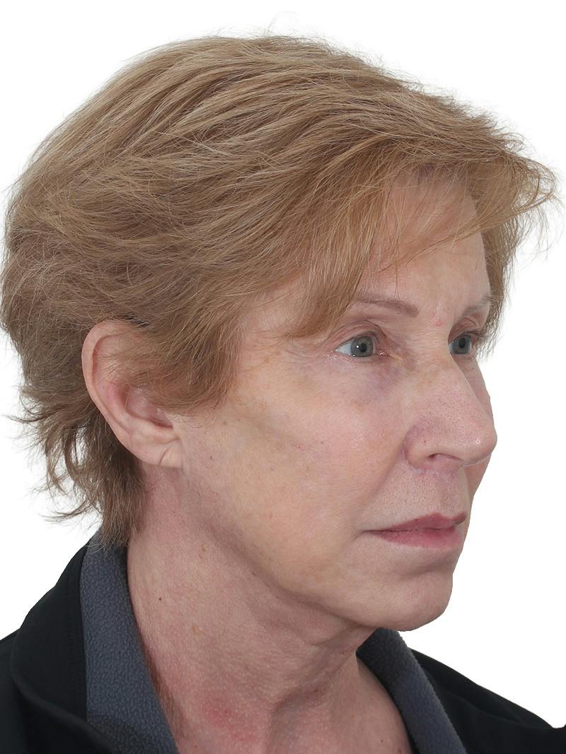 Blepharoplasty Before & After Gallery - Patient 189456 - Image 3
