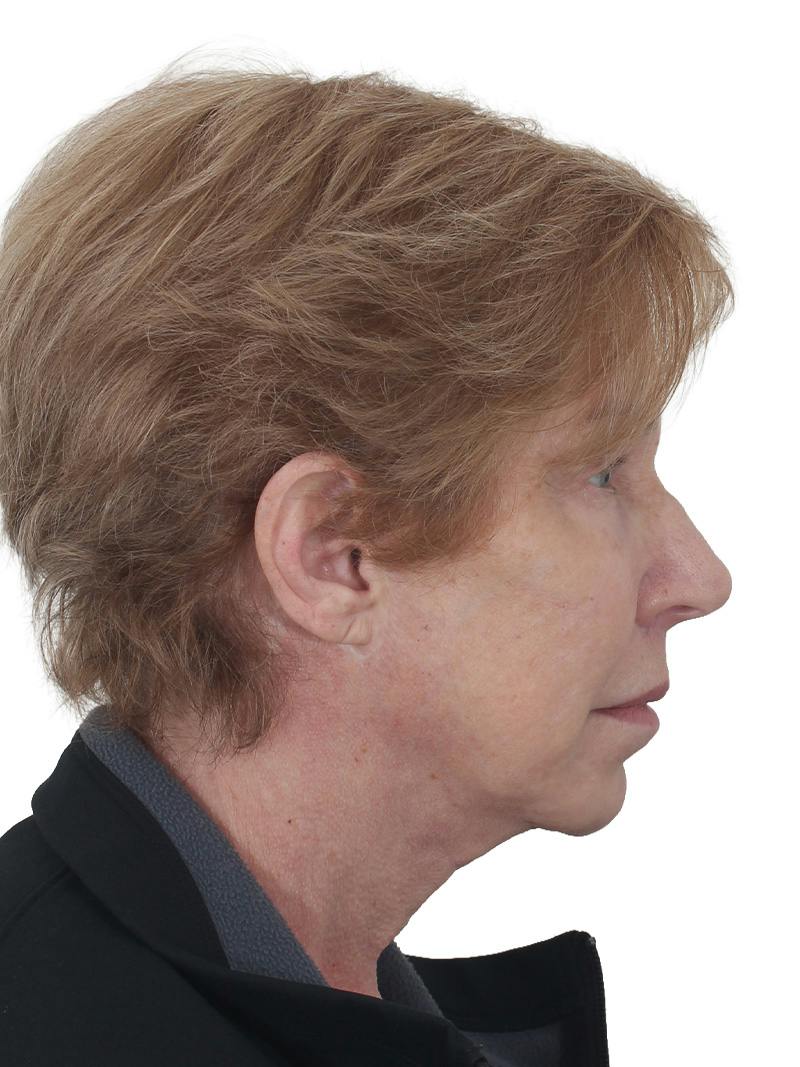 Blepharoplasty Before & After Gallery - Patient 189456 - Image 5
