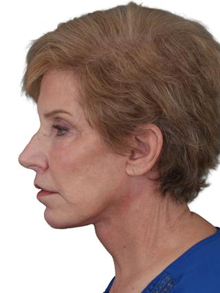 Blepharoplasty Before & After Gallery - Patient 189456 - Image 12