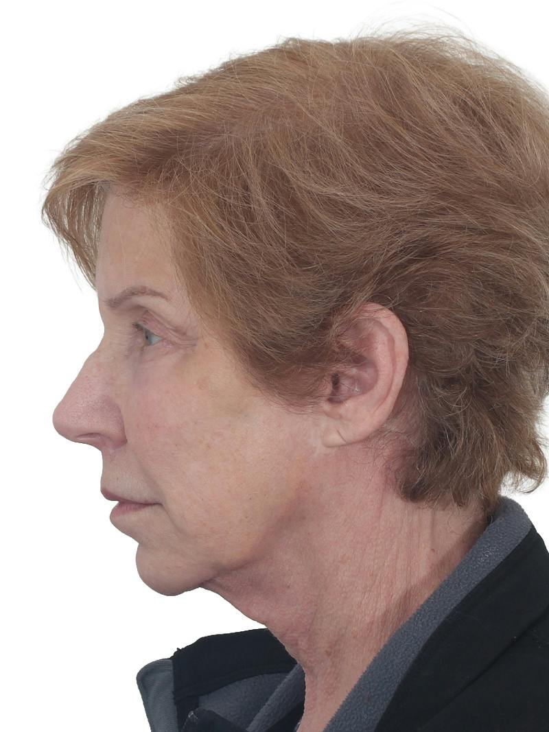 Blepharoplasty Before & After Gallery - Patient 189456 - Image 11
