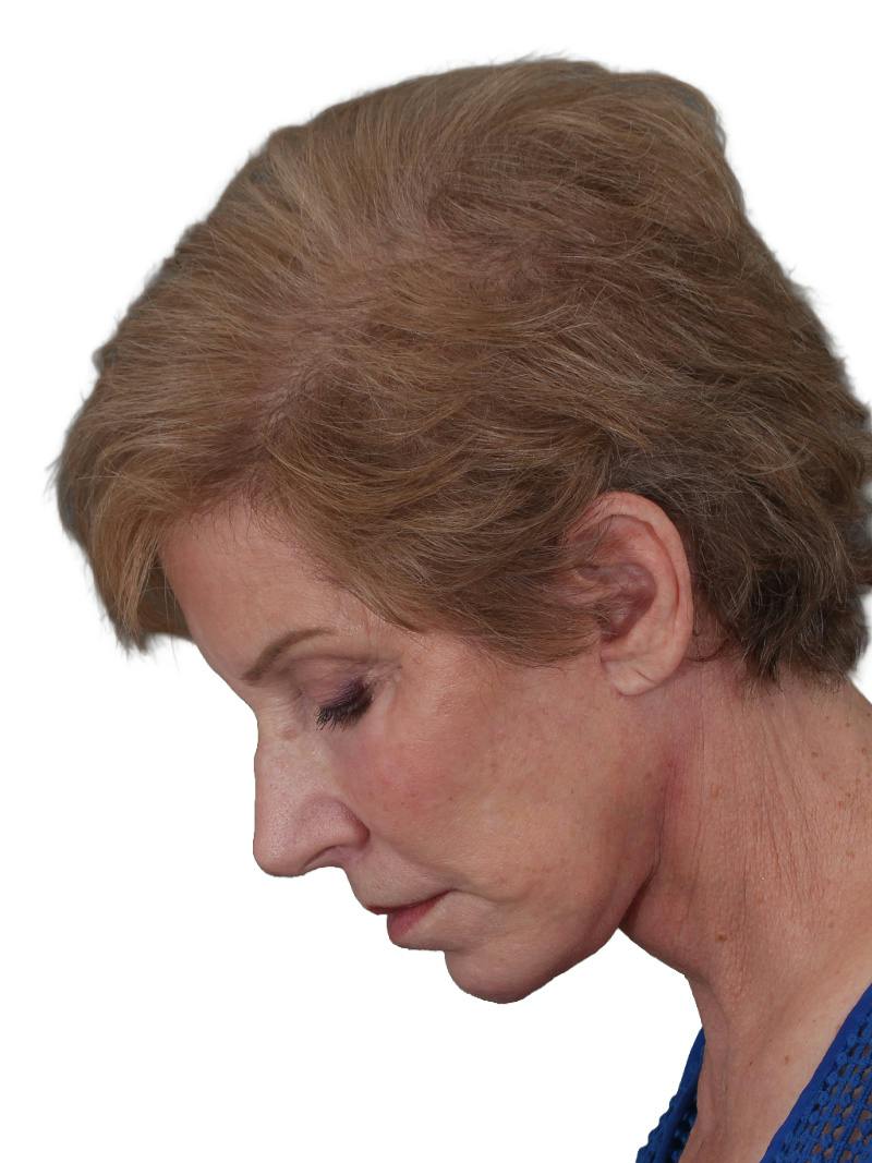 Blepharoplasty Before & After Gallery - Patient 189456 - Image 14