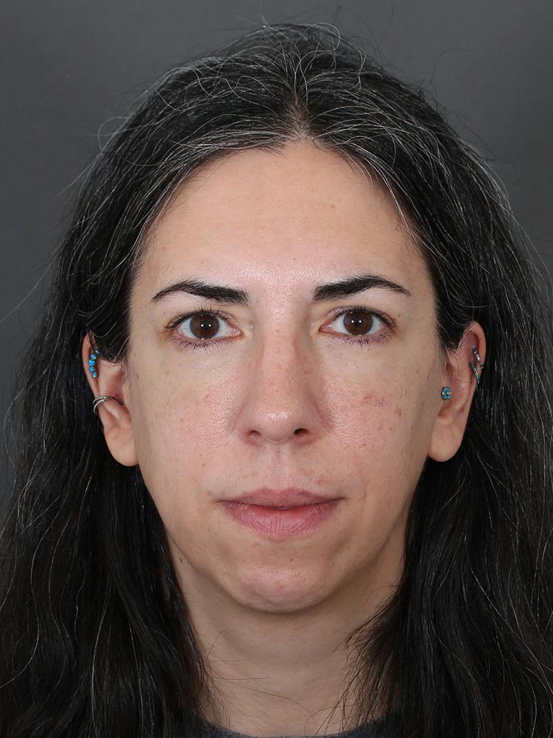 Blepharoplasty Before & After Gallery - Patient 225517 - Image 2