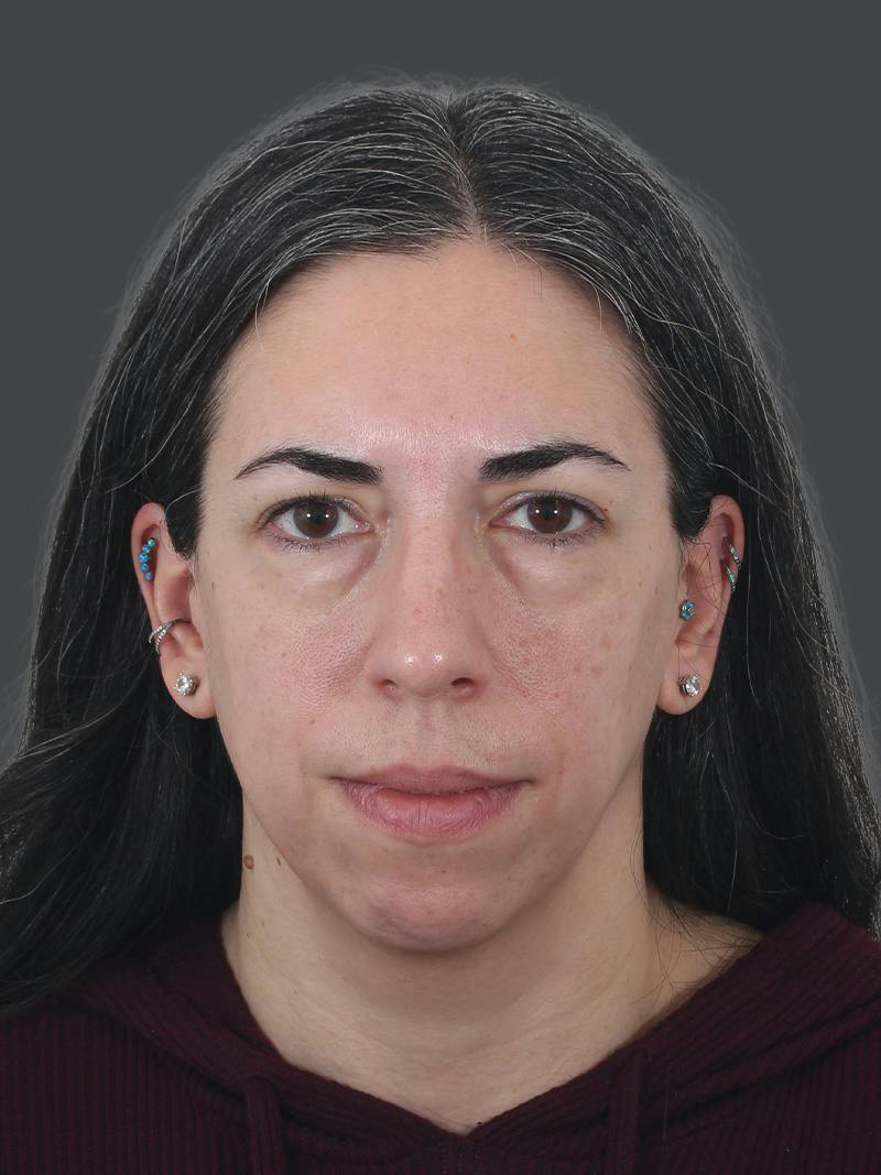 Blepharoplasty Before & After Gallery - Patient 225517 - Image 1