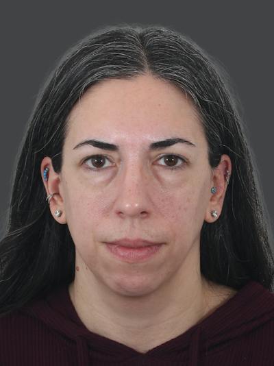 Fat Transfer Before & After Gallery - Patient 205051 - Image 1