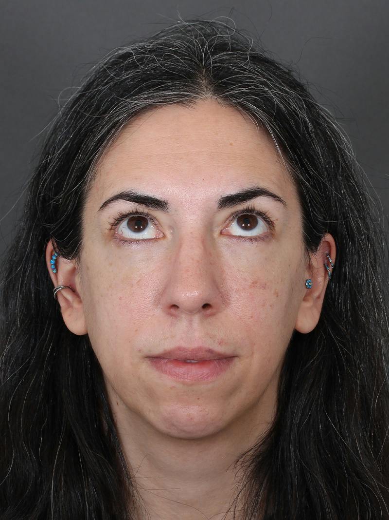 Blepharoplasty Before & After Gallery - Patient 225517 - Image 4