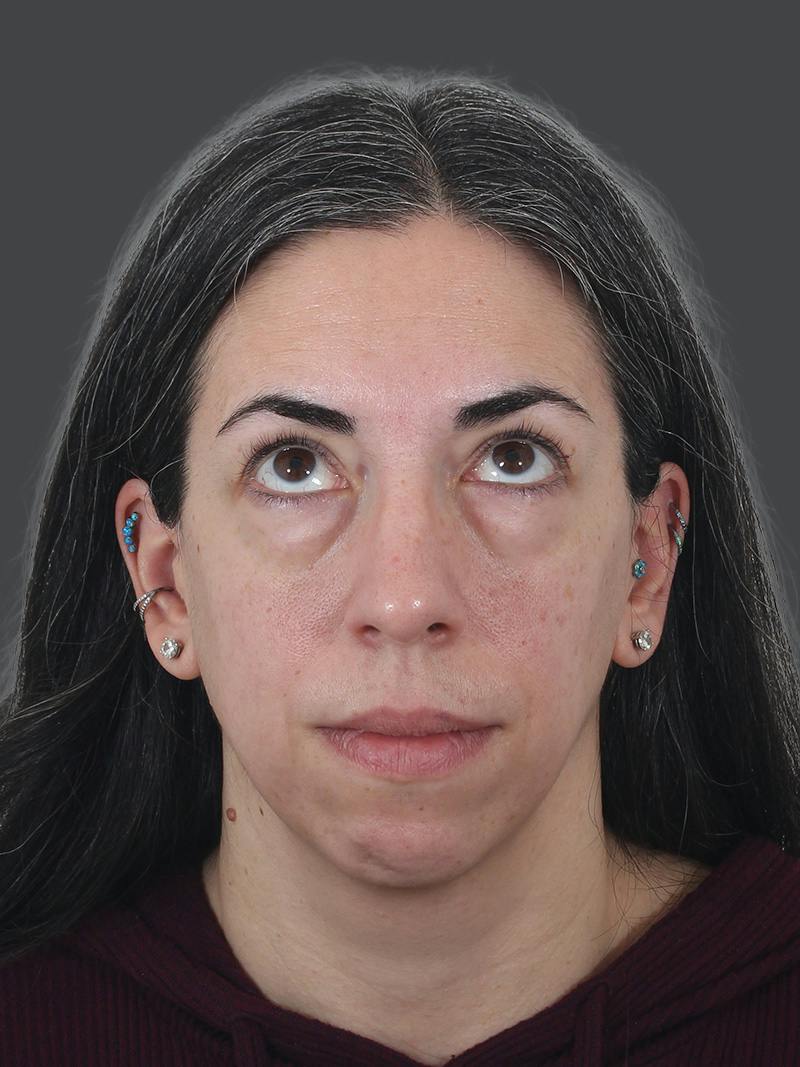 Blepharoplasty Before & After Gallery - Patient 225517 - Image 3