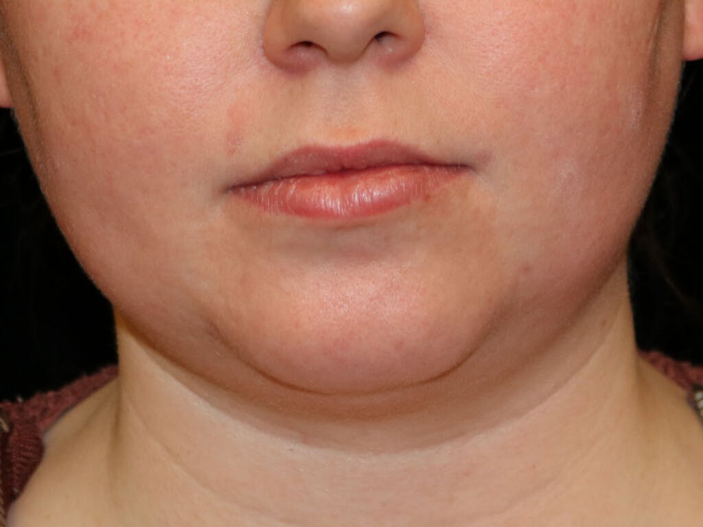 Chin Augmentation Gallery - Patient 39191356 - Image 1