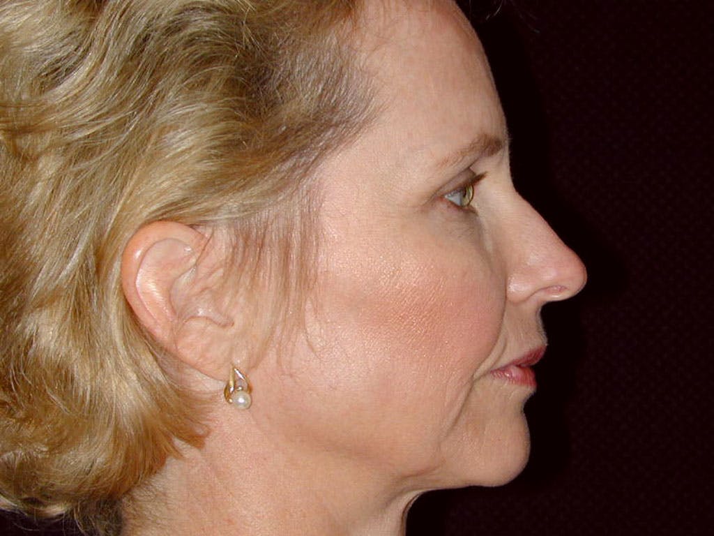 Chin Augmentation Gallery - Patient 39191374 - Image 5