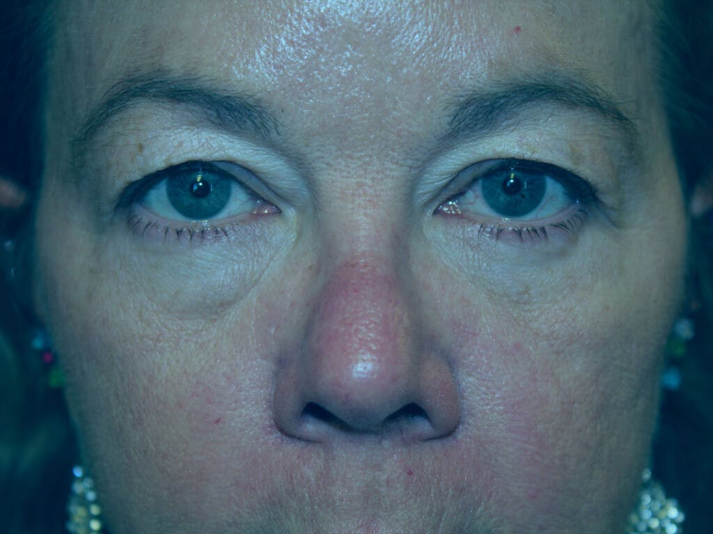 Eyelid Surgery Gallery - Patient 39199986 - Image 1
