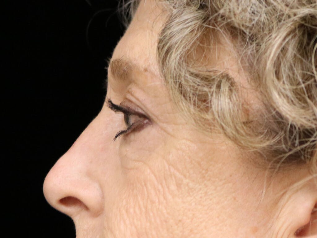 Eyelid Surgery Gallery - Patient 39200154 - Image 7