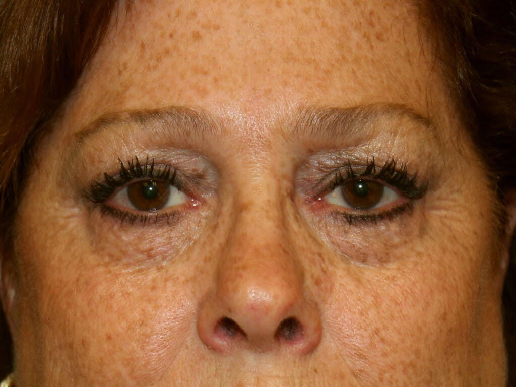 Eyelid Surgery Gallery - Patient 39200162 - Image 1