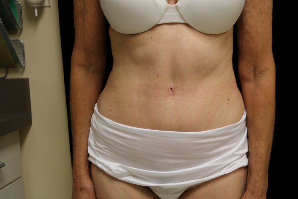 Before and after Tummy Tuck surgery in San Francisco with Dr. Delgado
