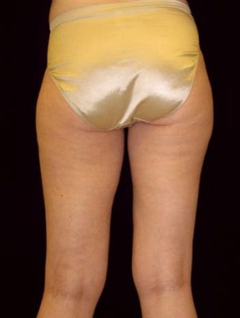 Liposuction Gallery - Patient 39209112 - Image 1