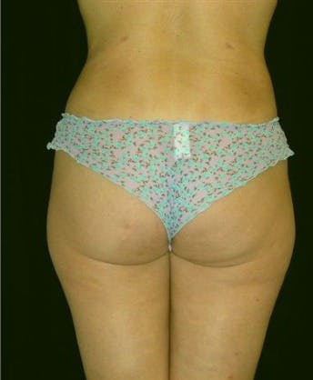 Liposuction Gallery - Patient 39209144 - Image 2