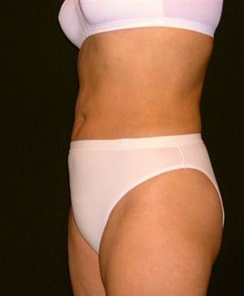 Liposuction Gallery - Patient 39217575 - Image 2