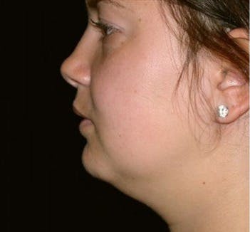 Liposuction Gallery - Patient 39217584 - Image 1