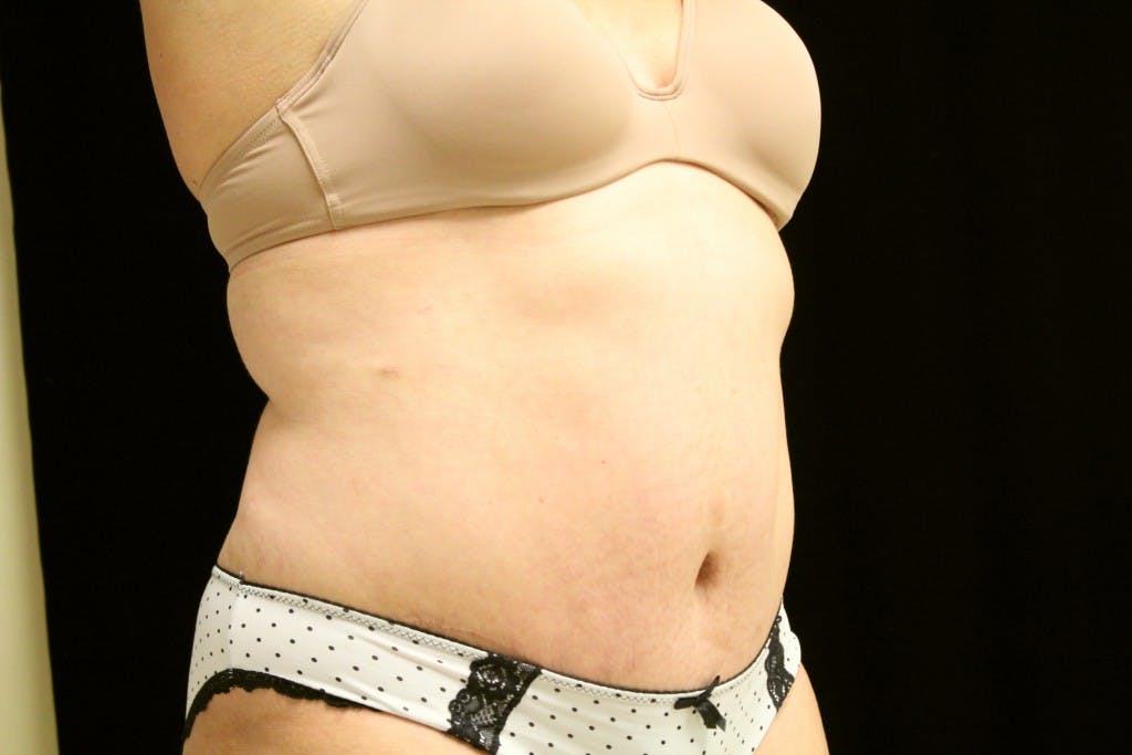 Tummy Tuck Gallery - Patient 39217587 - Image 4