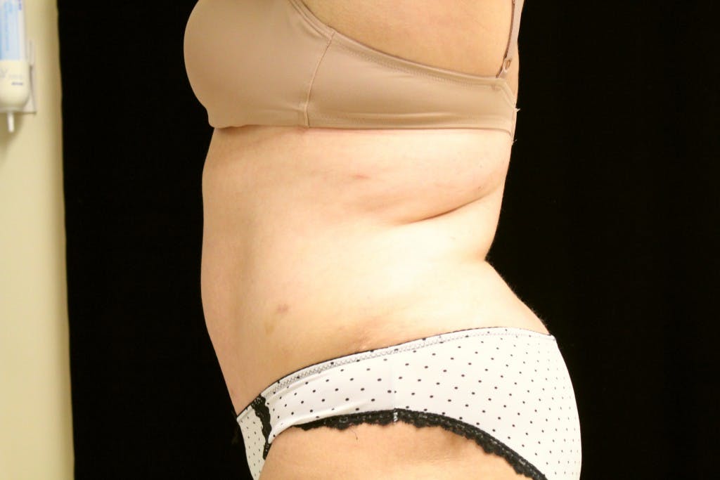 Tummy Tuck Gallery - Patient 39217587 - Image 5