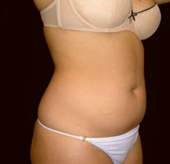 Liposuction Gallery - Patient 39217588 - Image 1