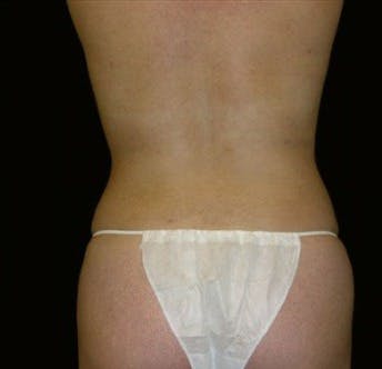 Liposuction Gallery - Patient 39217591 - Image 2