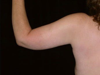 Before and after an Arm Lift in San Francisco with Dr. Delgado