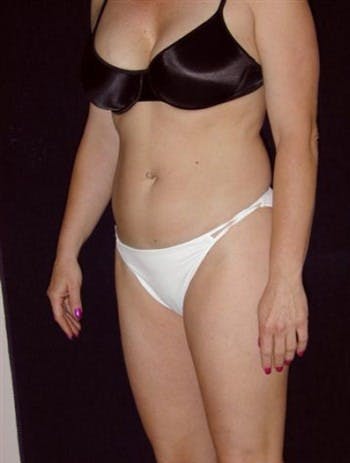 Liposuction Gallery - Patient 39217641 - Image 1