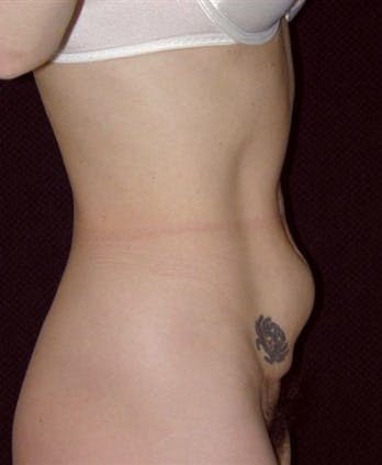 Liposuction Gallery - Patient 39217670 - Image 1