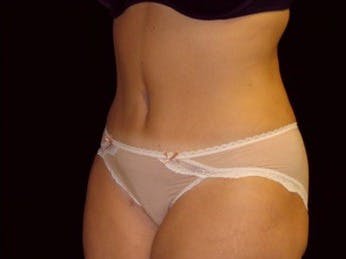 Tummy Tuck Gallery - Patient 39217673 - Image 2