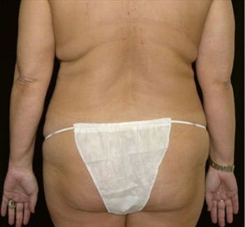 Liposuction Gallery - Patient 39217674 - Image 1
