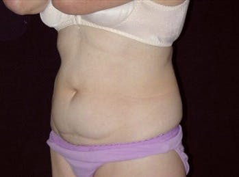 Tummy Tuck Gallery - Patient 39217675 - Image 1