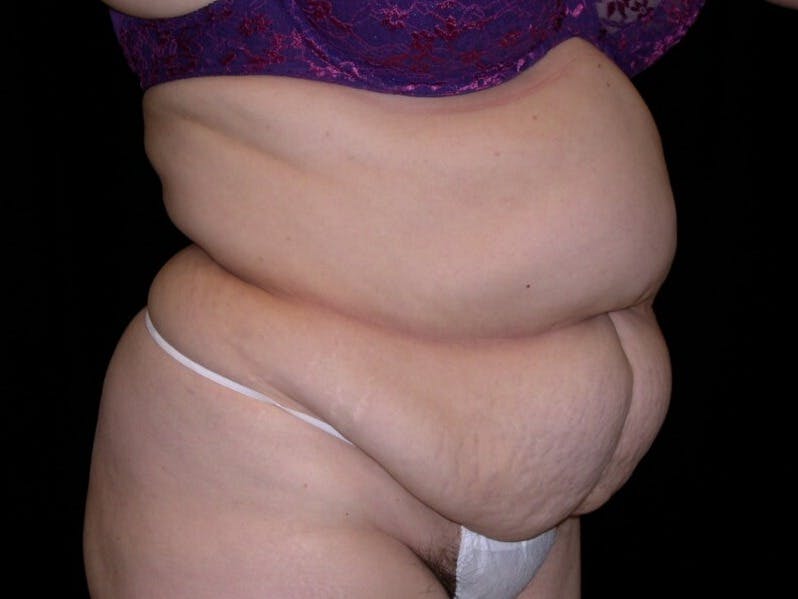 Tummy Tuck Gallery - Patient 39217691 - Image 1