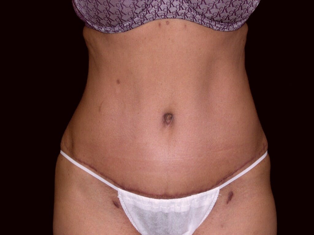 Tummy Tuck Gallery - Patient 39226153 - Image 2