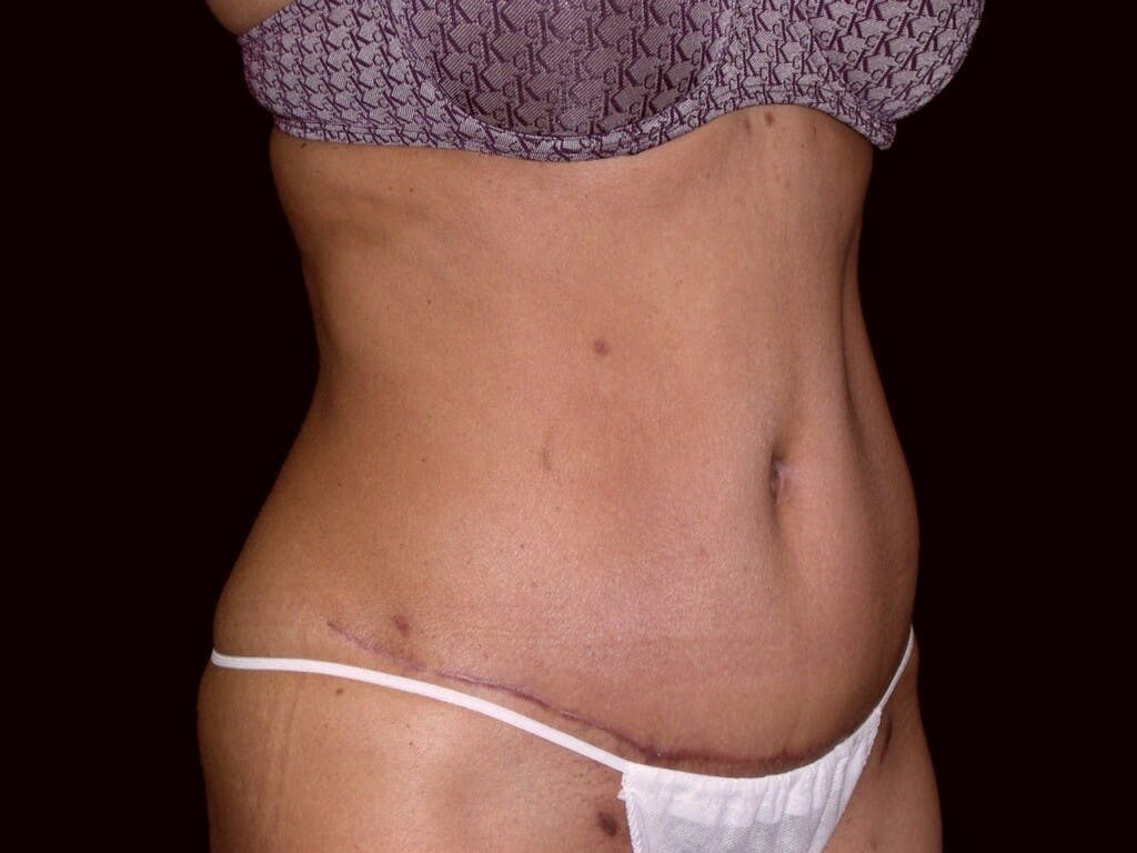 Tummy Tuck Gallery - Patient 39226153 - Image 4
