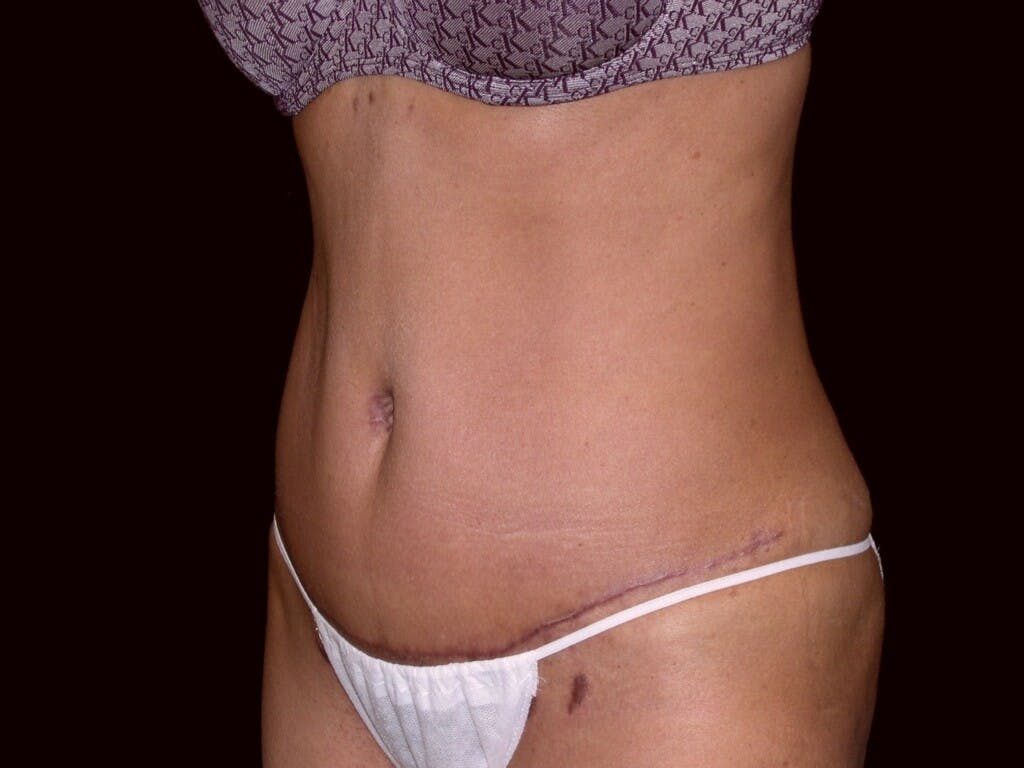 Tummy Tuck Gallery - Patient 39226153 - Image 6