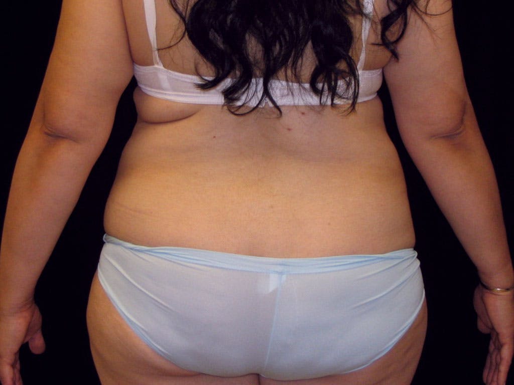 Liposuction Gallery - Patient 39226171 - Image 1