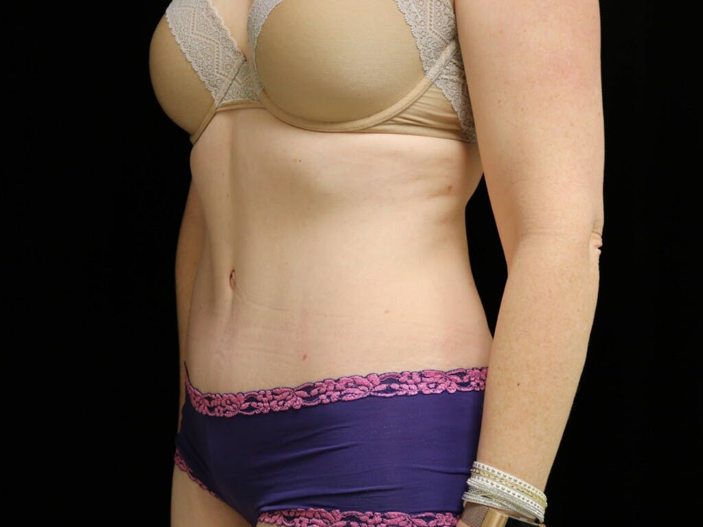 Tummy Tuck Gallery - Patient 39235555 - Image 8