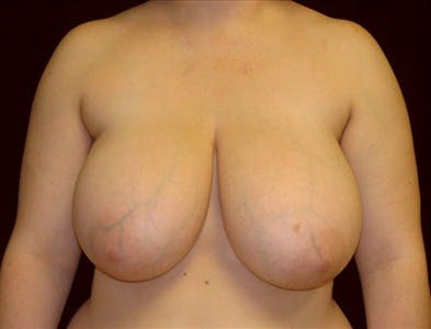 Breast Reduction T Incision Gallery - Patient 39235570 - Image 1